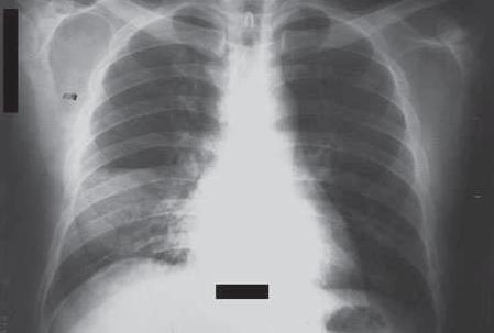 TORAKSTA ELEMENTER LEZYONLAR KONSOLİDASYON: Akciğerlerin hava içeren yapılarında (alveol ve
