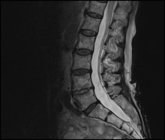 çıkabileceği söylendi. 15 gün sonra hastaya EMG çekildi ve hastada her iki alt ekstremite kaslarında ciddi denervasyon tespit edildi ve bu bulgular ciddi BLSP ile uyumluydu.