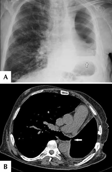 Plevral hastalıkların görüntülenmesi: Akciğer grafisi temelinde görüntüleme yöntemlerinin değerlendirilmesi Resim 16. Pnömonektomi sonrası bronkoplevral fistül.