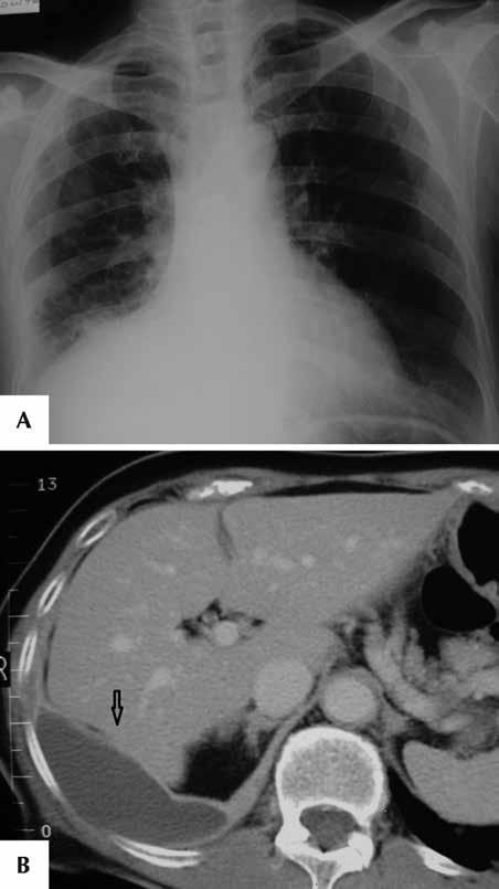 Plevral hastalıkların görüntülenmesi: Akciğer grafisi temelinde görüntüleme yöntemlerinin değerlendirilmesi Resim 3.