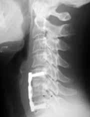 Postoperatif dönemde segmental kifotik açılanma, servikal lordoz kaybı, servikal aksın bozulması ve sonuç olarak aksiyel boyun ağrısı basit diskektominin dezavantajlarıdır (8).