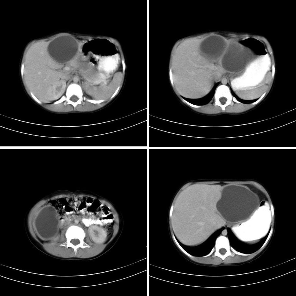 M. Kaya ve ark., Çocuklarda karaciğer kist hidatiklerine laparoskopik yaklaşım: rken dönem deneyimlerimiz Resim 1. BT görüntüleri. dan albendazol tedavisi verildi.