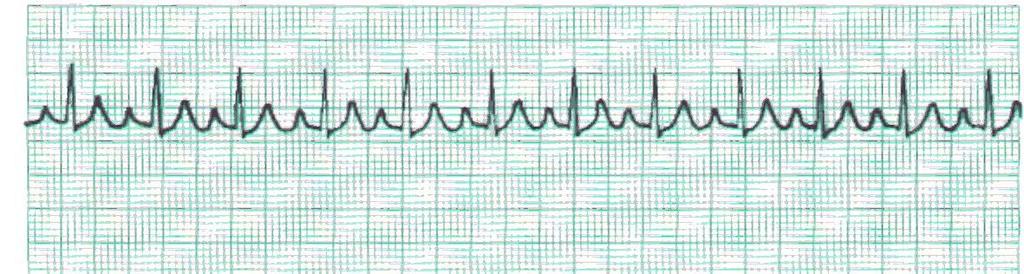 Atrial Taşikardi Birbirini takip eden üç veya daha fazla atrial ektopik atım atrial taşikardiyi oluşturur. Atrial impulslar AV nodda bloke olursa ventriküllere iletilemez.