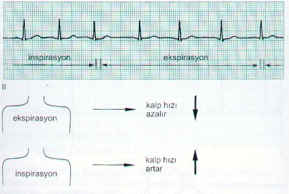 Sinüs Aritmisi Sinüs nodundan çıkan uyarılar düzensizdir. Düzensizlik sıklıkla inspiryum ve ekspiryum nedeniyledir.