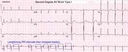 parasempatik yük artışına bağlı, pace gerekmez His-purkinje bloğu = Mobitz tip 2 (infranodal) 2.