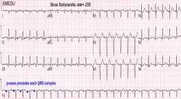 Sinüs Taşikardisi Sinüs Taşikardisi Sık görülür, fizyolojik bir uyaran sonrasında