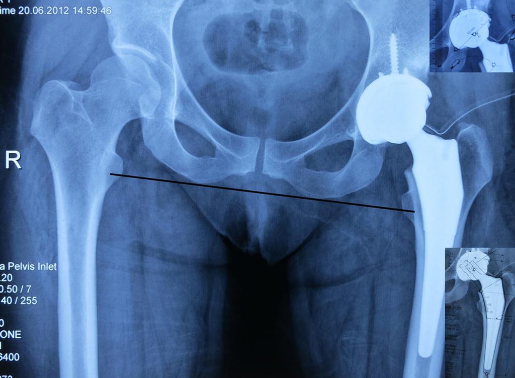 Ameliyat öncesi planlama, önemi 211 Şekil 3. Ameliyat sonrası görüntü. Ameliyat sonrası uzunluk kontrolü, iskium alt seviyesinden çizilen çizgiye göre eşit trokanter minor seviyeleri.
