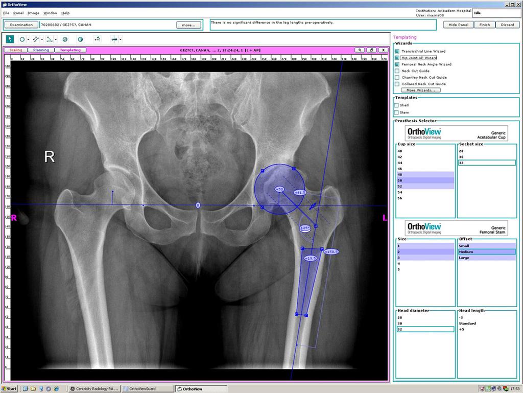 Ameliyat öncesi planlama, önemi 213 Şekil 5. Ameliyat öncesi dijital ortamda ölçüm. böyle bir durumda yüksek ofsetli femoral komponent seçeneği kullanılması gerekebilir.