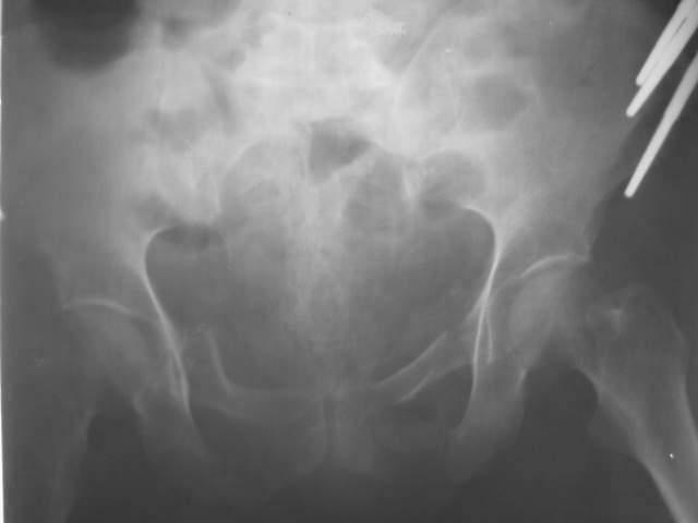 Cilt : 22, Sayı : 2 Tile Tip B Pelvis Kırıklarının Tedavisinde Pelvik Mart 2008 Şekil 1b). Olgunun postop 2. gündeki X-ray görünümü. Şekil 1c). Olgunun postop 1.yıldaki X-ray görünümü. Tablo 1.