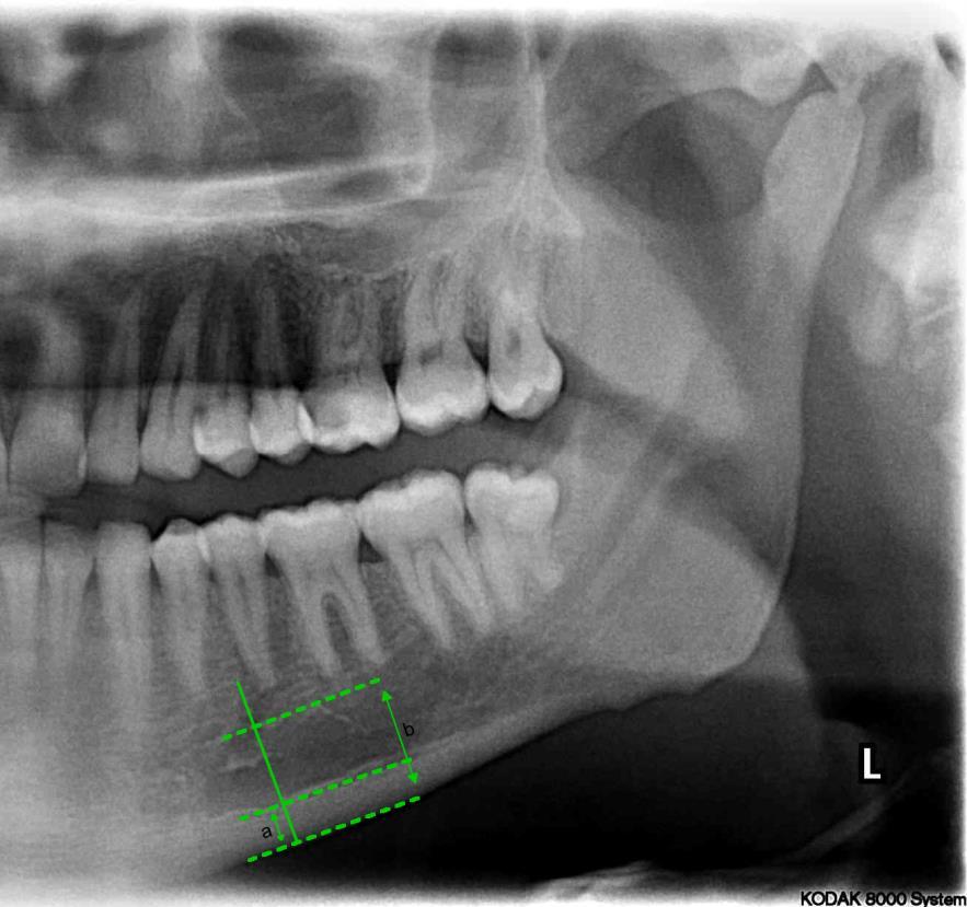 2.2.9 Panoramik Mandibular İndeks (PMI) Mandibular korteks kalınlığının mental foramen ile inferior mandibular korteks arasındaki uzaklığa olan oranıdır (a/b). Üst ve alt sınır ayrı olarak hesaplanır.