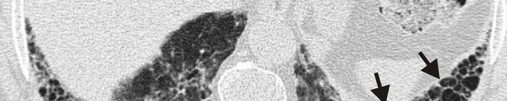 CT-histologic correlation of the ATS/ERS 2002 classification of idiopathic interstitial pneumonias. Radiographics. 2003; 23:1057-71. 3.