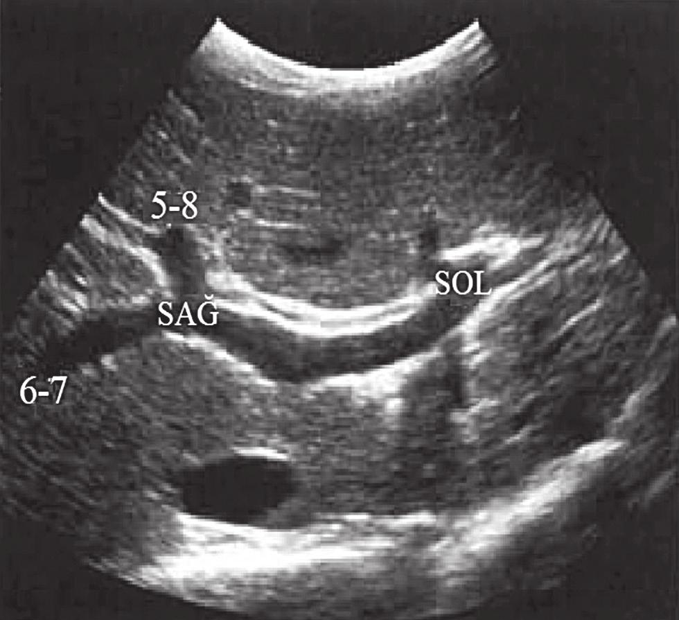 : Sonogram ile korele edilen görüntülerde ana portal veni, sağ ve sol dallarını görüyoruz. Sağ ve sol dallar karaciğer segmentlerinin transvers düzlemdeki ayırımını yapar.