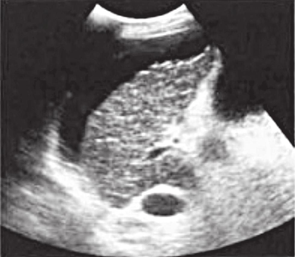 Portal Ven Trombozu Sonografide %67 oranında portal ven lümeni içinde ekojenik trombüs materyali, %48 oranında portal ven kollateralleri, %38 oranında