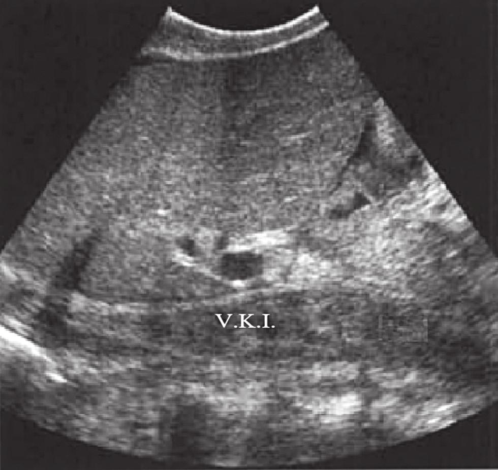 Resim 51. udd-chiari sendromlu hastada inferior vena kava (V.K.I.) trombüsü. İnferior vena kavanın ekojenik trombüs ile distandü göründüğü imaj.