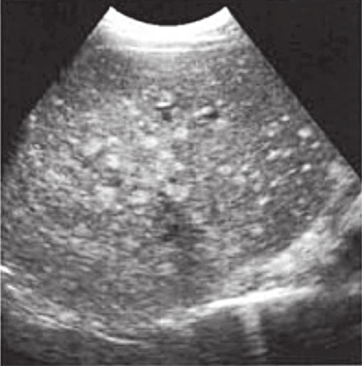 Hiperekojen metastazlar: Gastrointestinal sistem ve HCC metastazları ekojen olmaya meyillidir.