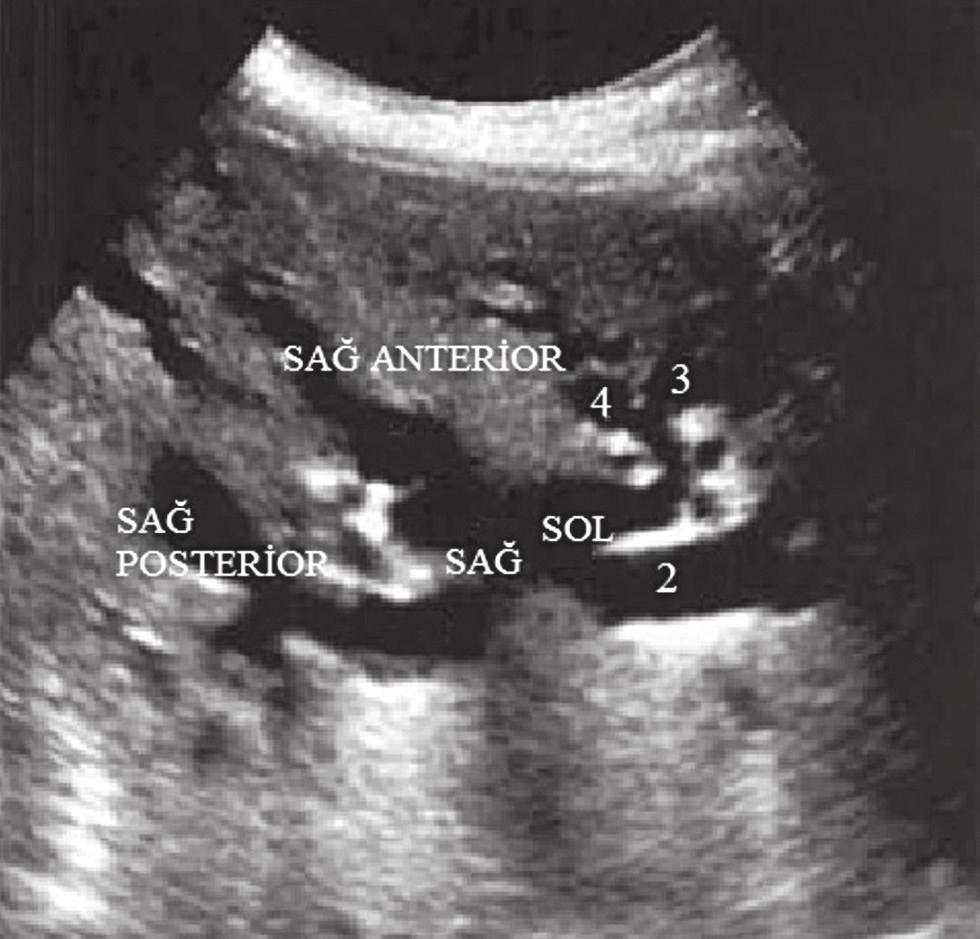 Distal kısmı ise anterior epigastrik yaklaşımla, longutidunal düzlemde probu sağa açılandırarak görüntülemeye çalışılmalıdır.