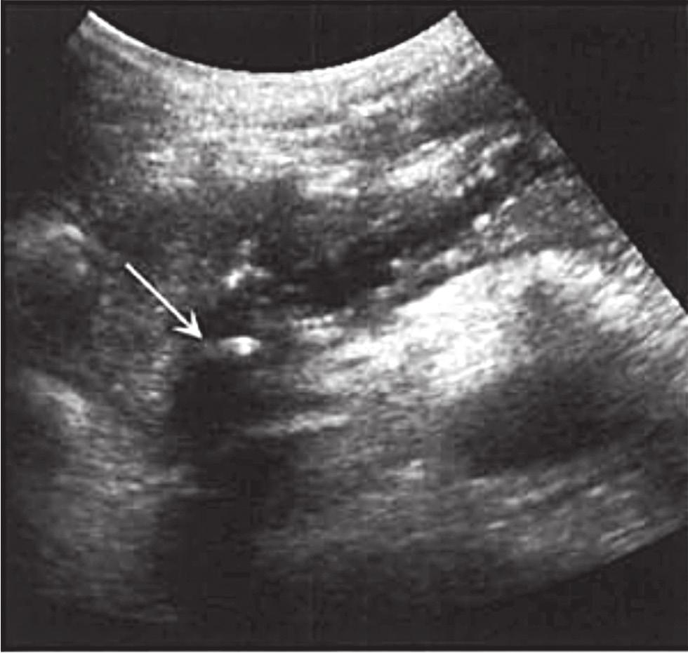 Pankreas bezindeki nekroz alanları heterojenite olarak izlenir. Resim 104. Akut pankreatitte hafif peripankreatik değişiklikler.