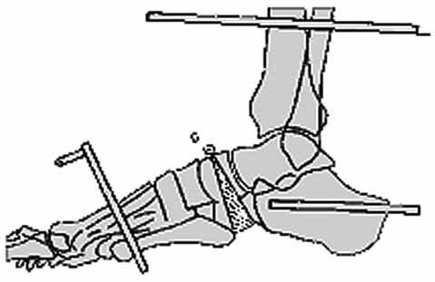 Kavusun merkezi Chopart ekleminin posteriyorunda ise talar-kalkaneal osteotomi (Şekil 44a, b), posteriyor orta ayaktaki kavus için küboid-naviküler osteotomi (Şekil 45a-c) ve orta ayak kavusu için