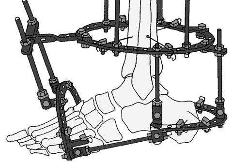 Medial ve lateral plantar rodlar günde 1 mm uzatılır. Ortadaki iki rod sabit kalırken posteriyordaki rod günde 1 mm uzatılır; bu işlem kalkaneustaki ekinusu düzeltir.