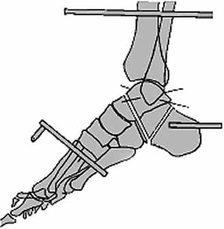 Ayak bileği ve ayak deformitelerinin İlizarov yöntemi ile tedavisi 233 Şekil 50.