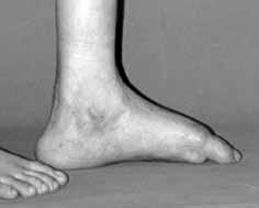 Pes kavus deformitesinde de kalkaneus eğim açsı artmıştır, fakat pes kalkaneusta ayak tabanı yere değmez.