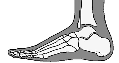 Eğer transfer edilecek tendon yoksa ayak bileği eklemi bozuk ise ve daha önce yapılan işlemler başarısız kalmışsa tibiotalar eklem artrodezi yapılabilir.