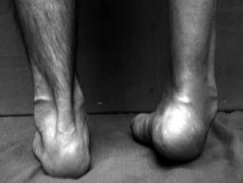 Klinik Kalkaneus varus deformitesinde topuk içeri doğru döner ve hasta ayak tabanı ile değil ayak tabanının dış kenarı ile basarak yürür.