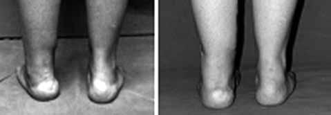 Topuk valgus deformitesi Tanım Kalkaneus ekseni tibia longitudinal ekseninin 5 mm kadar lareralinde seyreder ve ona paraleldir.