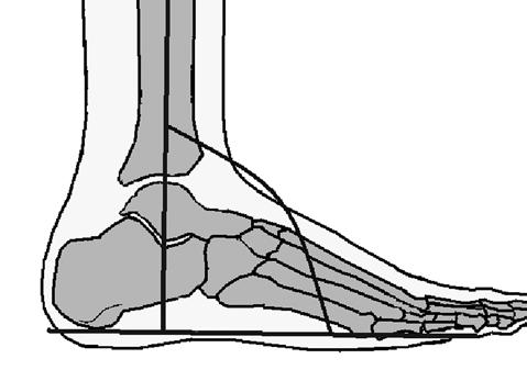 SAGİTTAL PLAN AYAK DEFORMİTELERİ 1- Ekinus Deformitesi Tanım Sagittal planda ayak bileğinin sıfır başlangıç pozisyonundan 45 derece plantar fleksiyona kadar herhangi bir açıda sabit durması ve aktif