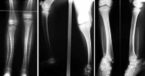 femoral kondil hipoplazisi, top-soket ayak bileği, tarsal koalisyon, metatarsus adduktus ve lateral parmakların yokluğu gibi patolojilere de sık rastlanılır.