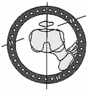 Distal halkaya lateral rotasyon yaptırılarak valgus deformitesi, posteriyor roddan da distraksiyon yaptırılarak prokurvatum deformitesi düzeltilebilir.