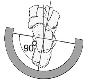 (c) Kalkaneus adduksiyon deformitesinin düzeltilmesi için yarım halkanın her iki ucunu birleştiren çizgi kalkaneus eksenine dik olmalı ve yarım halkanın medial ucu lateral ucundan daha fazla