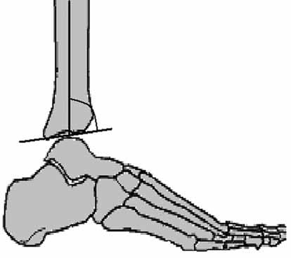 218 TOTBİD Dergisi 81 135 Şekil 10. Kalkaneometatarsal, anteriyor distal tibial açılar. I. Klasik Yöntemler 1.