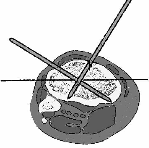 İkinci tel tibia anterolateral yüzünde patella lateral kenarından aşağı doğru çizilen vertikal çizginin hemen arkasından ve fibula başının merkezinden çizilen horizontal çizginin yaklaşık 5 mm