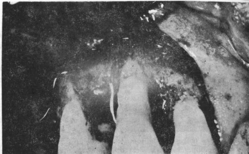 REFRACTORY PERİODONTİTİS Resim 7 : Kare içinde çıplak dentin bölgesindeki tübülün görünümü (SEM X 2000) ve büyük büyütmede alanı kaplayan