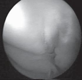 ARTROPLAST ARTROSKOPK CERRAH / JOURNAL OF ARTHROPLASTY & ARTHROSCOPIC SURGERY 9 Resim 1: Medial femoral kondildeki Grade III lezyonun görünümü. Resim 4: Cerrahi iþlemden sonra sahanýn görünümü.