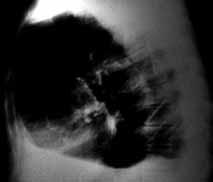 Ancak gö üs radyografileri ile plevra s v s, plevra kal nlaflmas ve tümör her zaman ay rdedilemeyebilir. Bu durumda ultrasonografi, BT, MR gibi ilave görüntüleme yöntemlerine baflvurulur.