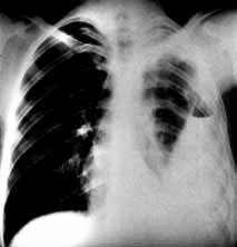 Plevra radyolojisi damarlarda itilmeye yol açan loküle kolleksiyonlar olarak izlenir (Resim 4). Kal nlaflm fl visseral ve parietal plevrada kontrast tutulumu mevcuttur.