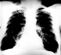 Plevra radyolojisi sekonder bronfl içi ya da parankim içi tümörler, interstisyel akci er hastal klar ) olabilir (19).