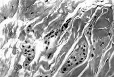 Karpal tünel sendromunda transvers karpal ligaman ve fleksör tenosinovyum örneklerinde histopatoloji 75 Kontrol grubundaki hastalardan al nan transvers karpal ligaman örneklerinin üçü (%37.