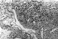 dejenerasyon saptand (Tablo I). Örneklerin hiçbirinde fibrozis, vaskülarite art fl, sinovyal hücre proliferasyonu ve amiloid birikimi görülmedi.