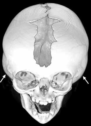 hipotelorizm, lateral orbita duvar hipoplazisi ve endokranial çentiklenme gibi metopik sinostoza özgü diğer özellikler görülmez (Şekil 13) (94).
