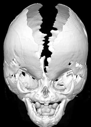 Anterior ve lateral kemik ve yüzey