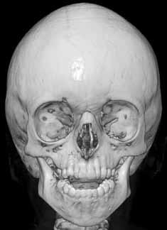 posterior fossa, tonsiller herniasyon (ok),