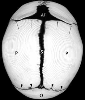 Metopik sütür (beyaz oklar), lambdoid sütürler (siyah ok başları), koronal sütürler