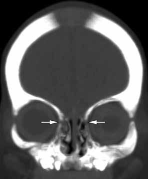 Sagital sütür (S) her iki parietal kemik ortasında izlenmekte (A,B,D).