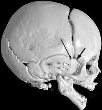 mastoid fontanel (P işaretli) görülmekte (C). D E Şekil 2: Minör sütürler.