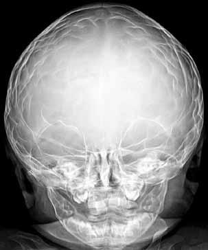 İleri düzeyde etkilenimi bulunan olgularda dövülmüş bakır manzarası görünümü kafa içi basınç artışının varlığına işaret eder (Şekil 3D, E) (90).