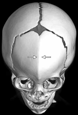 Şekil 7: Trigonosefali, metopik sinostoz, 8 aylık olgu, ön yukarıdan