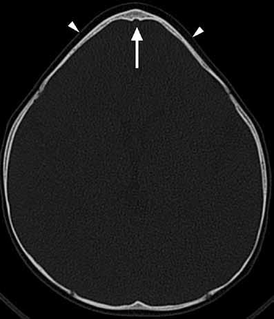 endokranial çentiklenme (ok) (C).